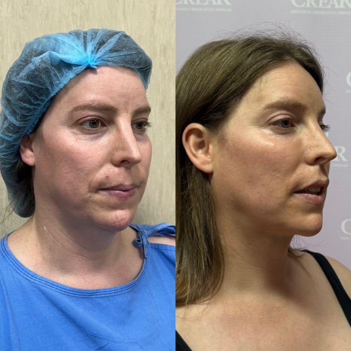 endolift laser a