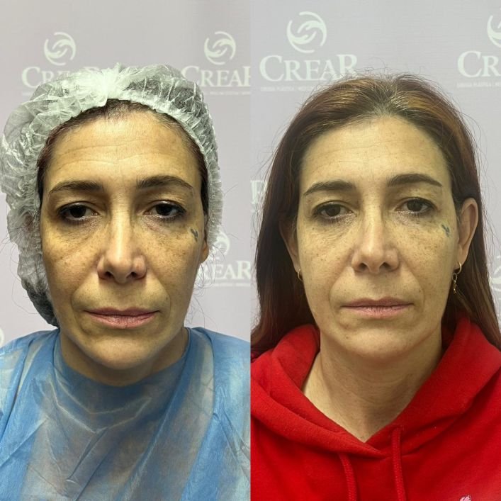 endolift laser b