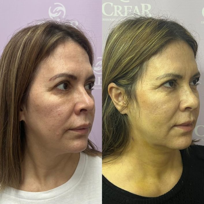 endolift laser c